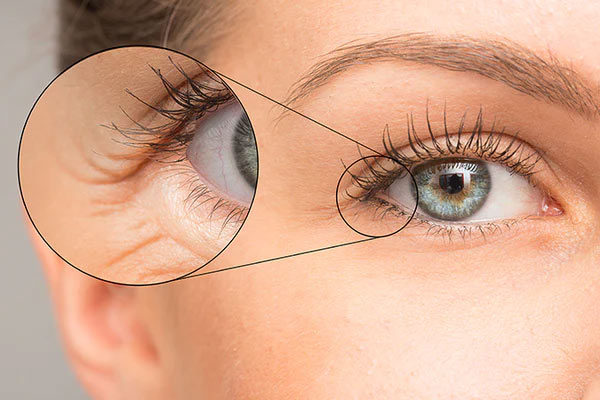 6 درمان چین و چروک دور چشم + روش موثر جلوگیری از آن