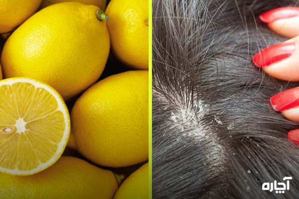 محلول ضد قارچ پوست سر با لیمو