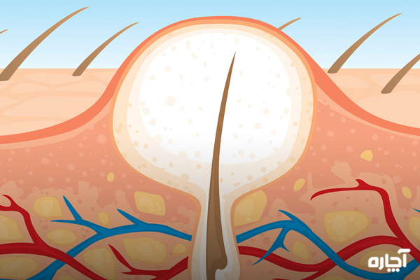 عفونت قارچی پوست سر چیست