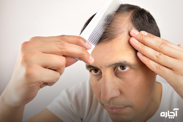 ریزش مو هورمونی مردانه