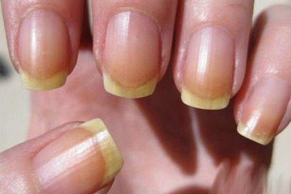 زرد شدن ناخن‌ها بعد از اکریلیک ناخن (3 علت + 4 درمان خانگی)