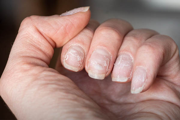 علت پوسته شدن ناخن + 5 درمان خانگی پوسته شدن ناخن‌ها